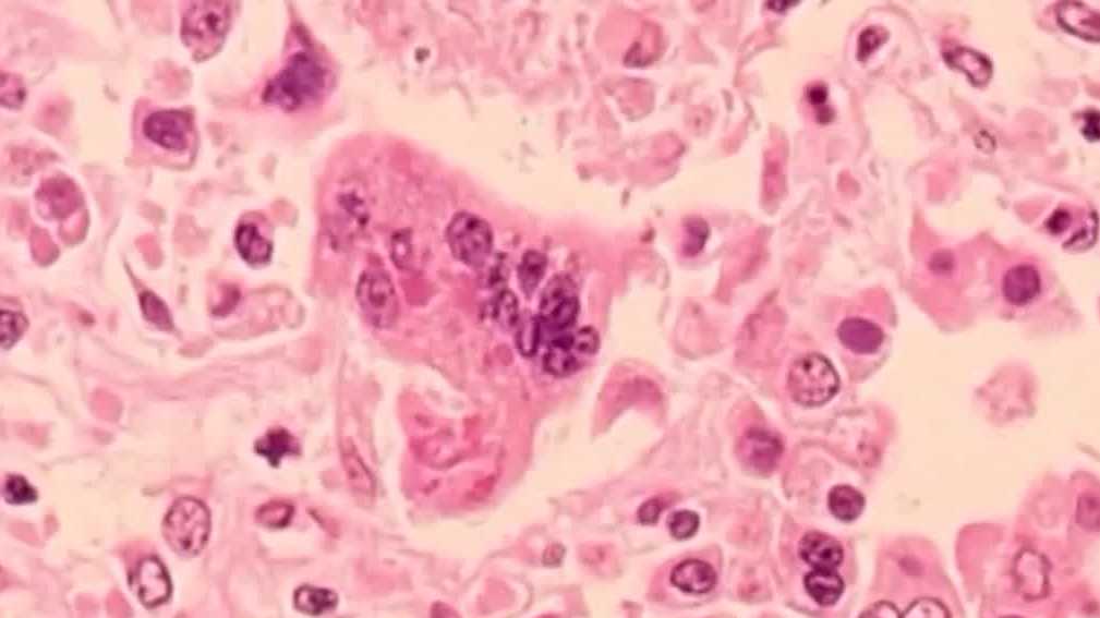 S-a confirmat că un rezident din New Hampshire a contractat rujeolă de la un călător S-a confirmat că un rezident din New Hampshire a contractat rujeolă de la un călător