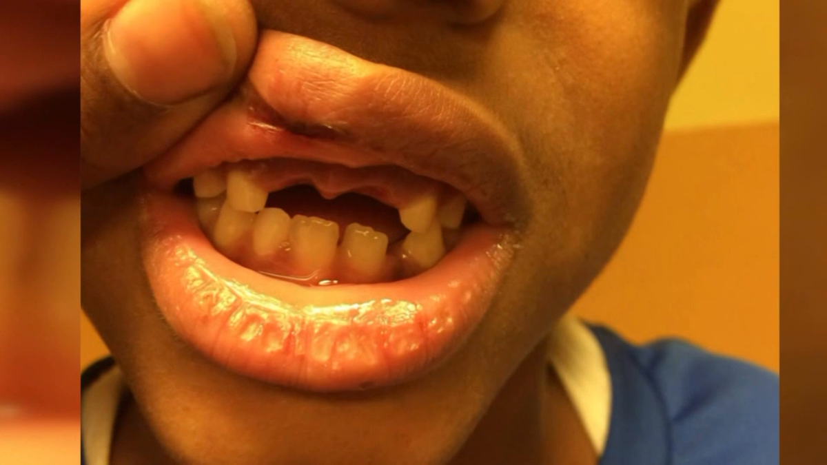 Teacher suspended after being accused of knocking out student's tooth