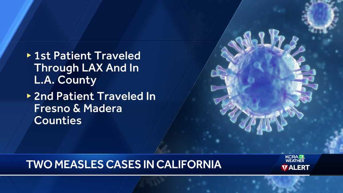 California counties urge vigilance with measles cases on the rise