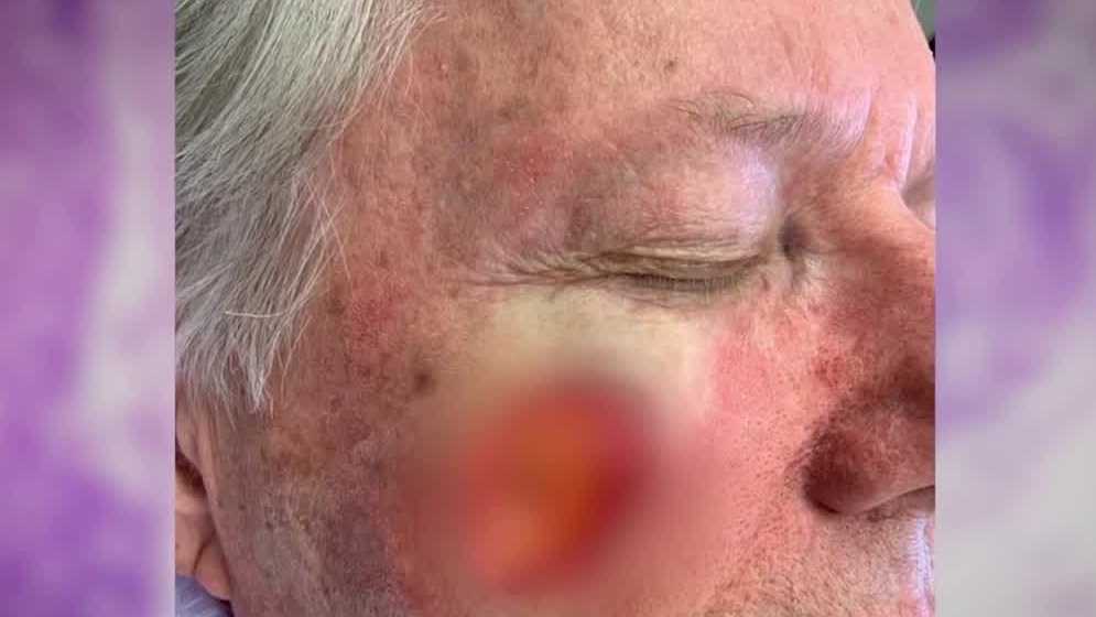 Melanoma survivor shares story to encourage Pittsburghers to prioritize skin health