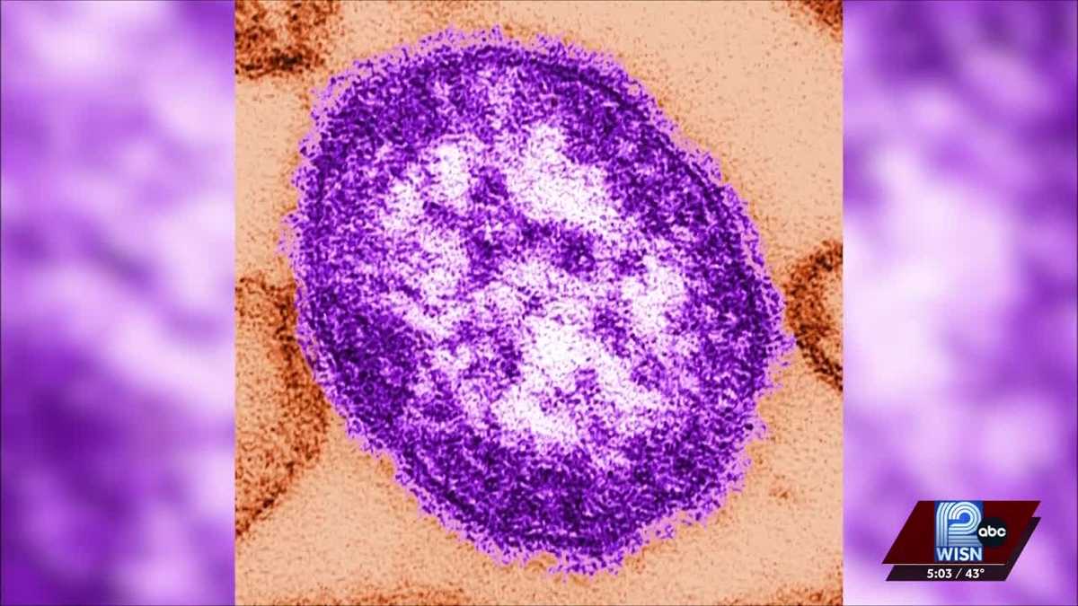 Wisconsin DHS gives update on measles cases in multiple counties