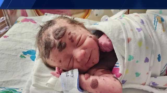 Omaha hospital treats baby with rare skin condition, his story - Vimarsana News