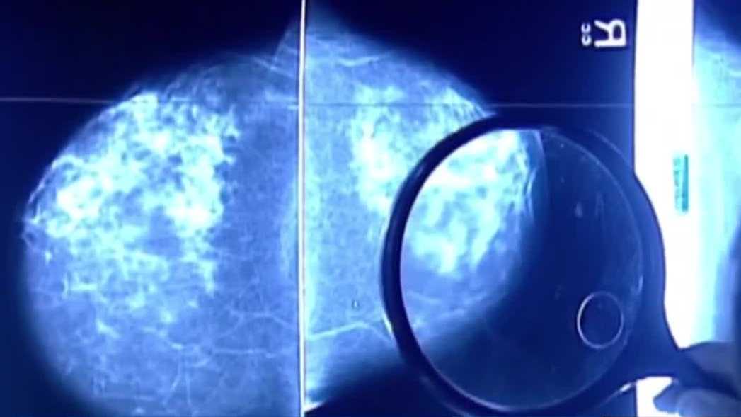 How does hormone replacement therapy affect breast cancer risk?