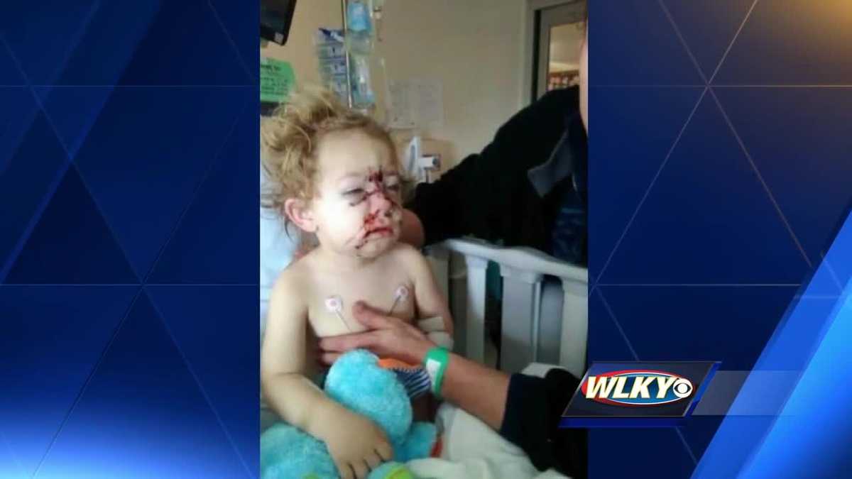 Toddler receives 50 stitches to face after pit-bull attack