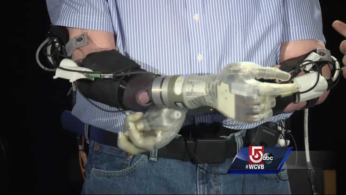 Latest technology in arm prosthetics give amputees a new chance at life