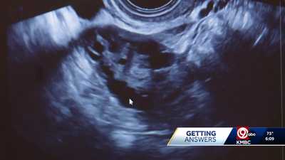UNDERSTANDING PCOS: Kansas City experts join roundtable, share local PCOS resources