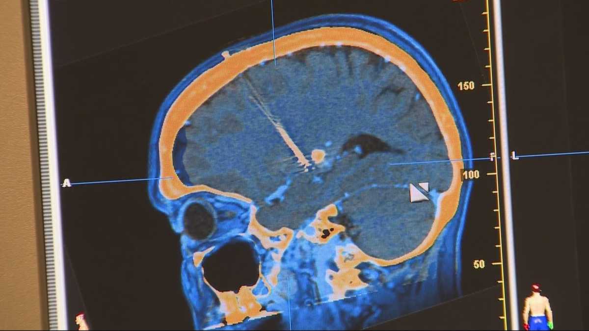 Revolutionary brain surgery technology being used by Boston hospital