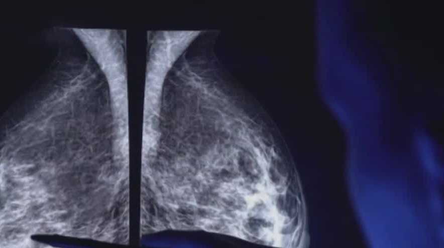 Drop in cancer diagnoses, routine screenings amid pandemic raise concerns