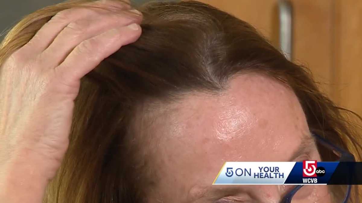 Hair growth medicine that comes in pill form - WCVB Boston