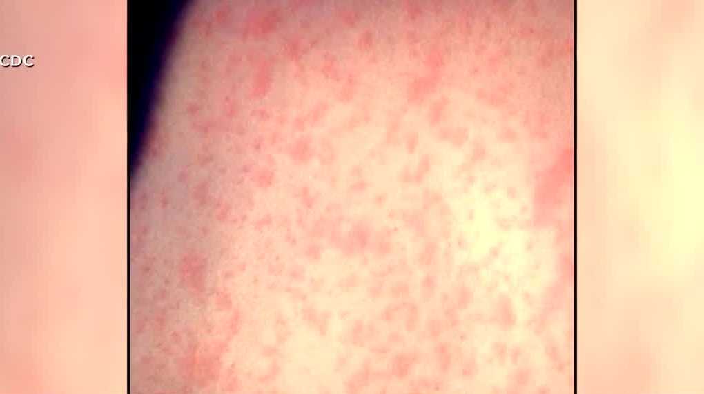 Experts say although possible to get measles despite being vaccinated, it offers protection
