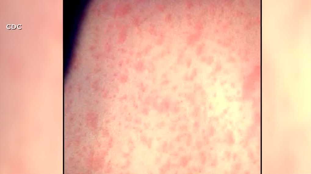 Experts say although possible to get measles despite being vaccinated, it offers protection
