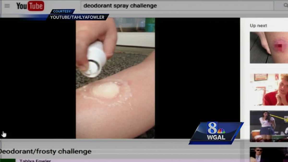 Dangerous "Deodorant Challenge" burns skin, cause infection