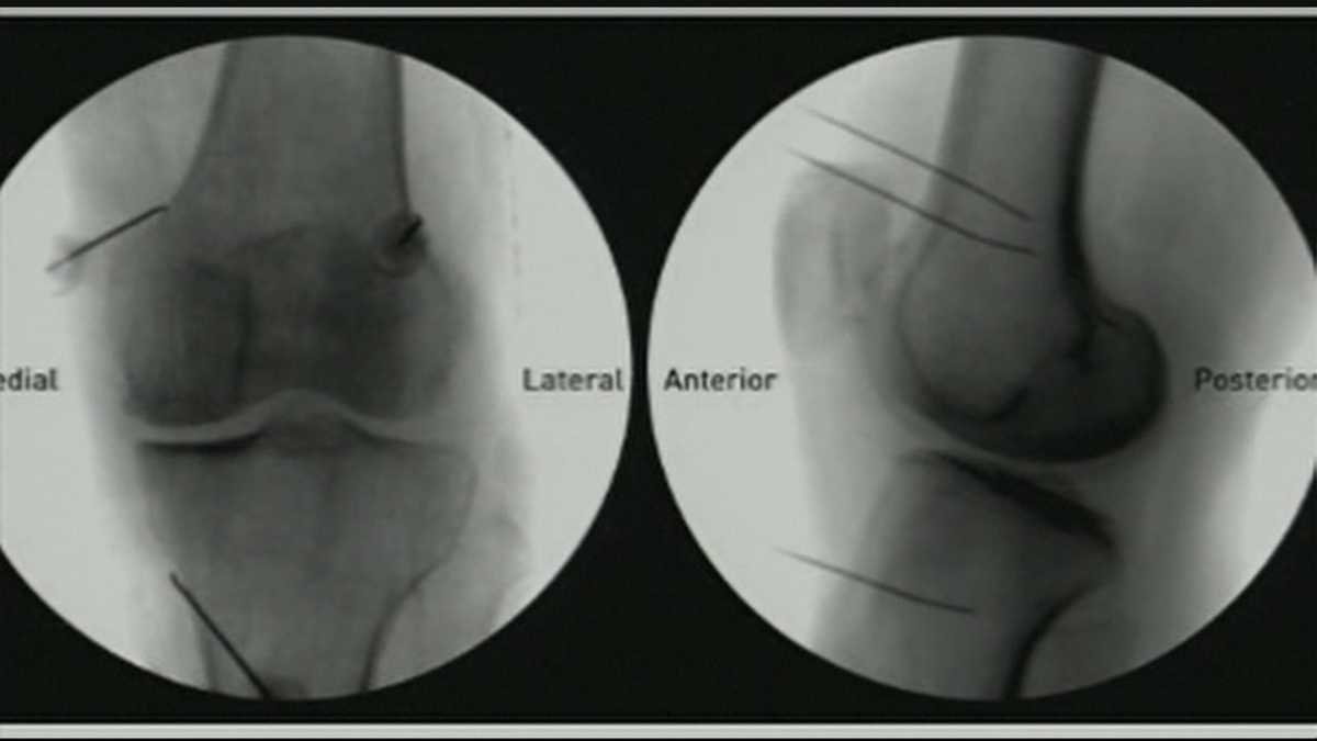 Radio frequencies used to heal knees
