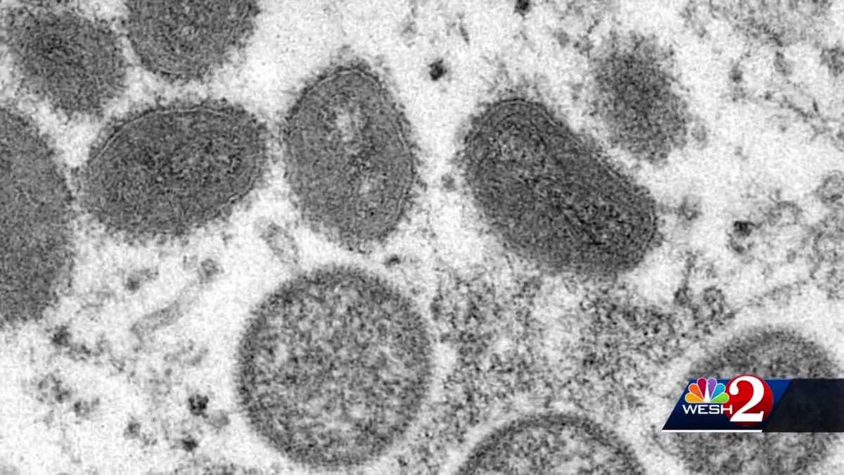 Monkeypox cases on the rise in Central Florida