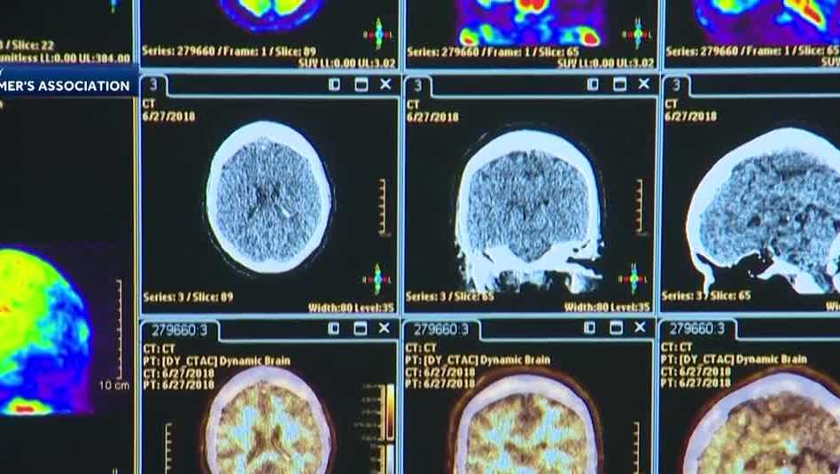 Upstate experts celebrate milestone in Alzheimer's, dementia research