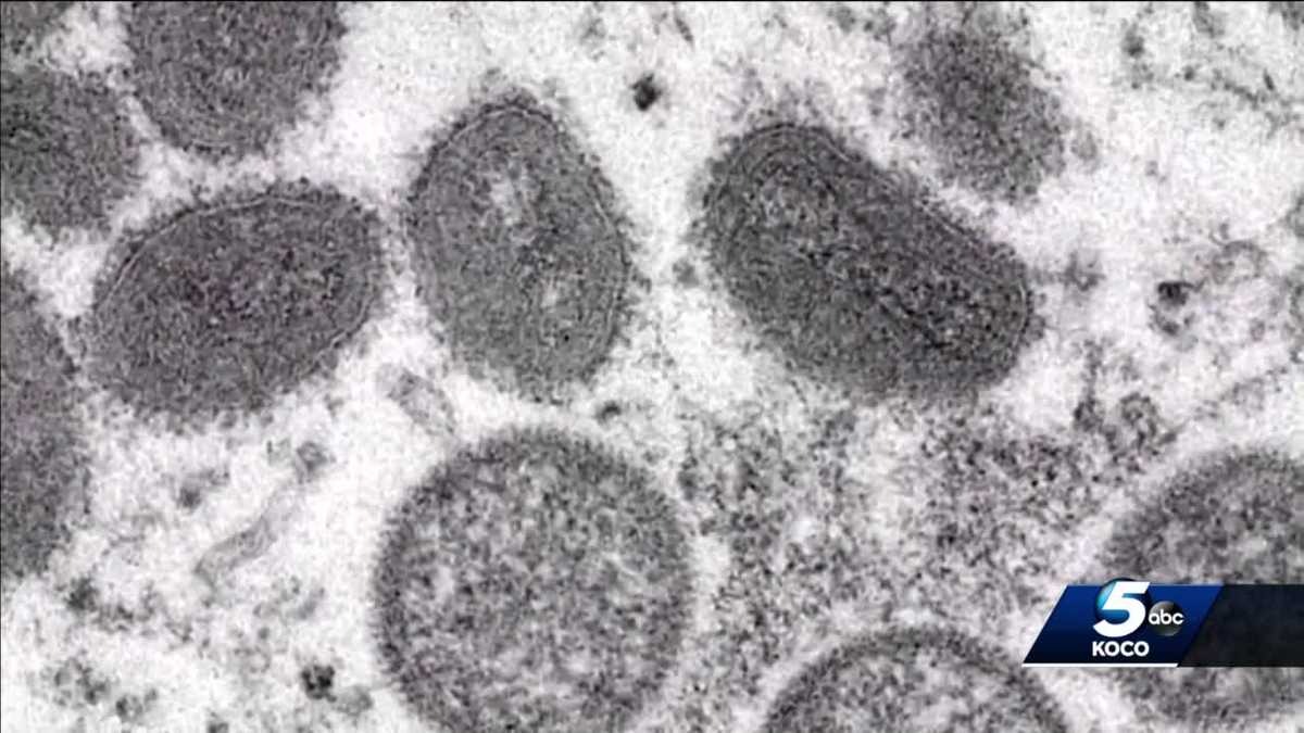 Oklahoma leaders expand criteria for monkeypox vaccine - KOCO