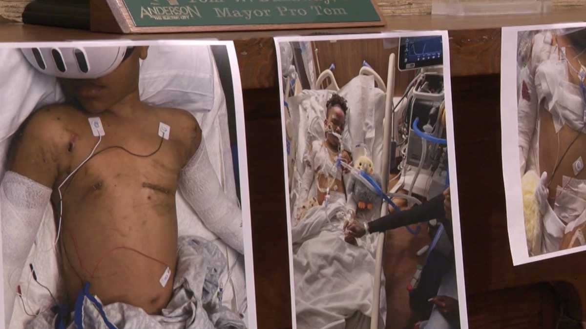 South Carolina Mother of boy mauled by dogs files lawsuit