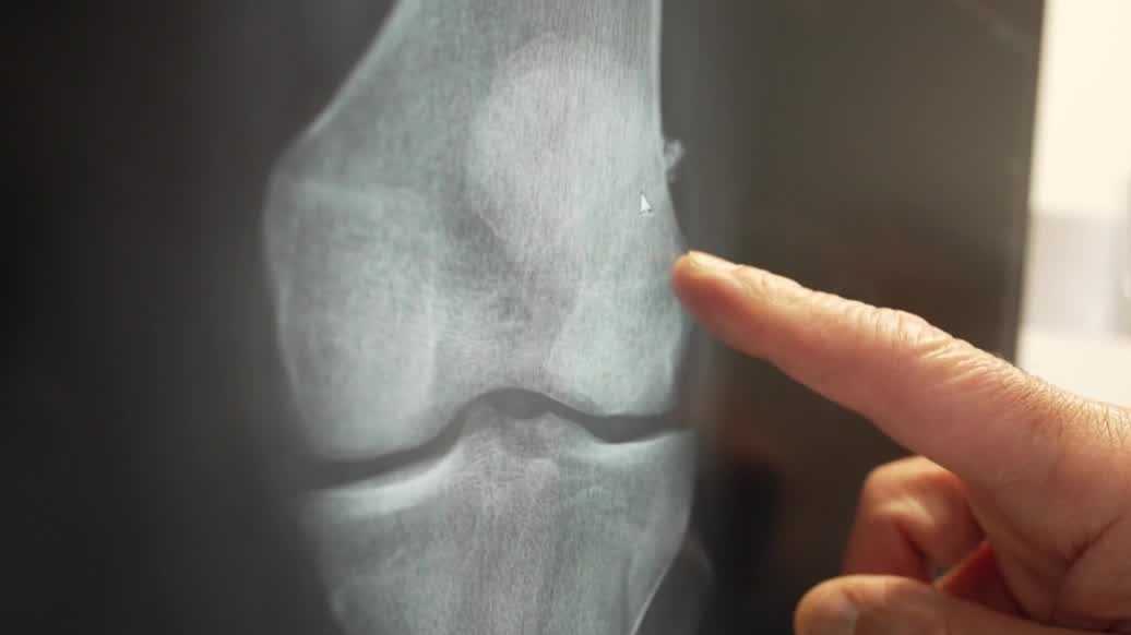 Naples company reinvents recovery as ACL injuries surge among young athletes
