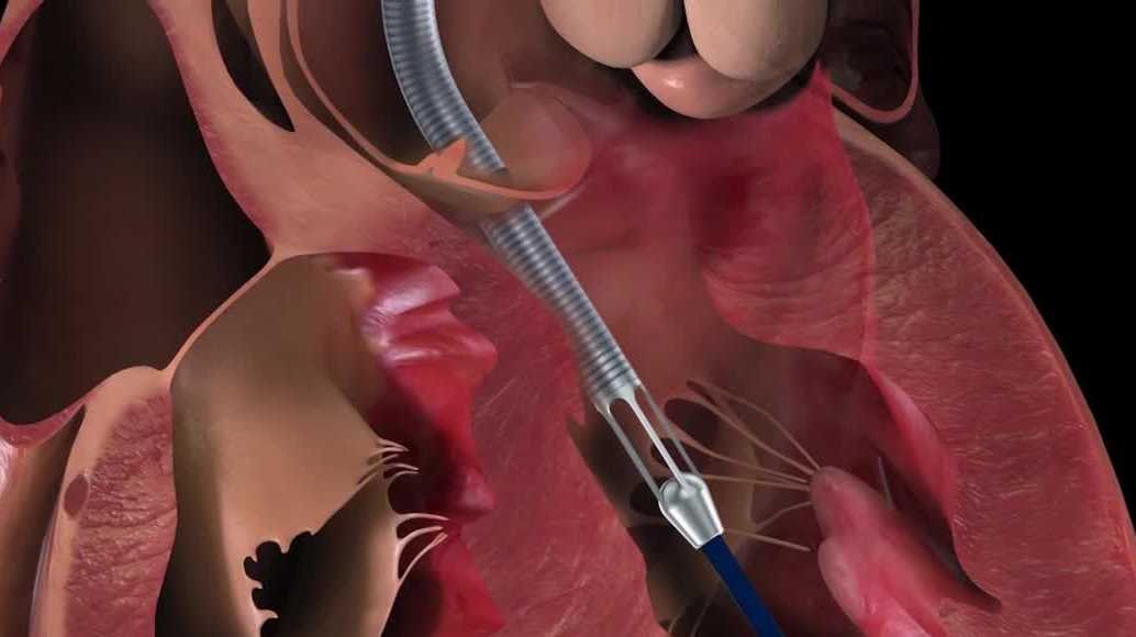 Southwest Florida woman recovers from severe heart attack with advanced NCH heart pump procedure