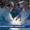 Concord man receives human kidney after pig kidney transplant