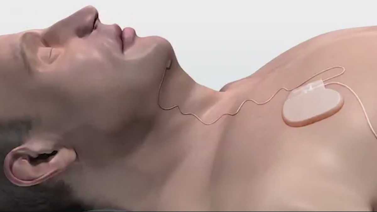 Those suffering from Sleep apnea hope new device will offer relief