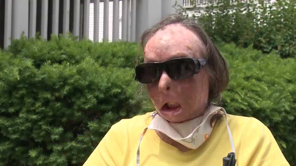 New Hampshire woman is first American to get second face transplant