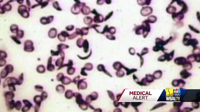 Sickle cell disease: Why patients need African American blood - Vimarsana News