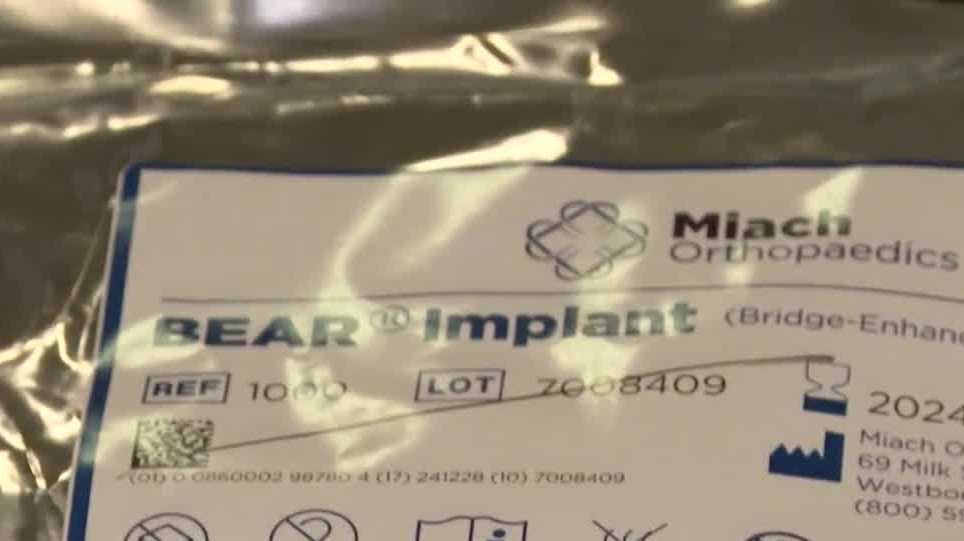 UNMCの医師が新しい形式のACL手術を実施