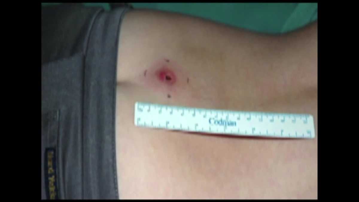 Flesheating ulcer spreading in Australia, and reasons remain a mystery