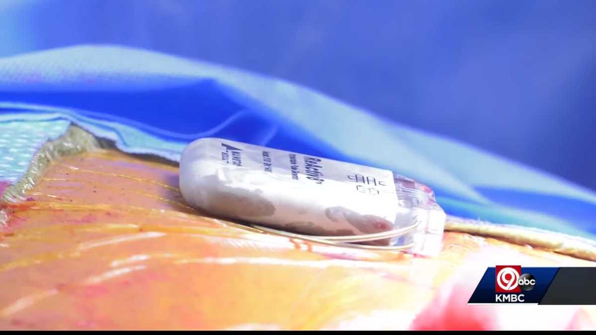 Kansas City doctor talks about implant that could help relieve chronic