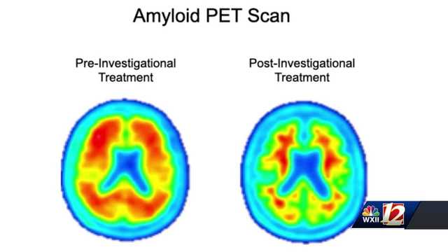 North Carolina: Alzheimer clinical trial - Vimarsana News