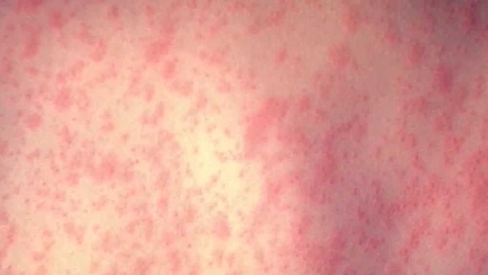 Measles cases reported among federal detainees in New Mexico