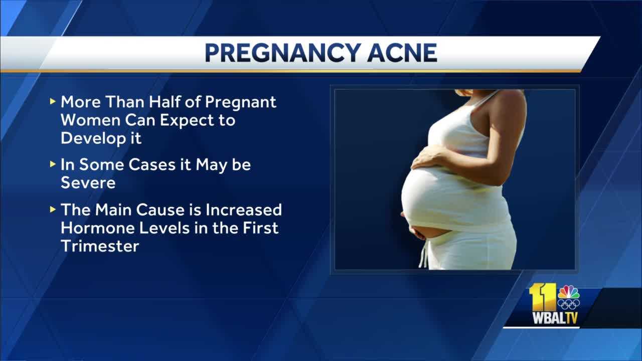 How To Deal With Acne During Pregnancy   Ae420f96 Cf68 4e0b A43c 3bb6f68d3841 Image 