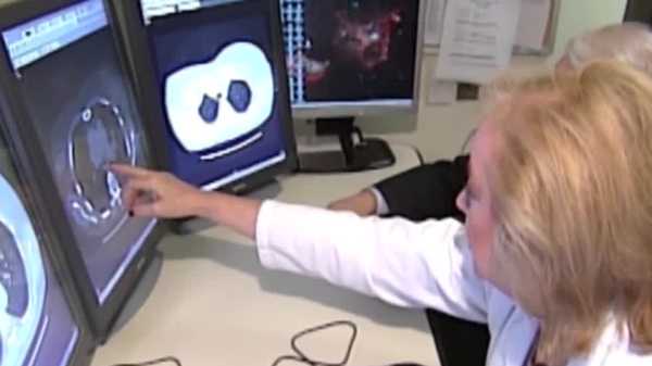 lung cancer screening