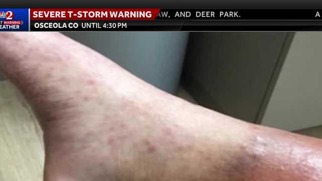 Florida one of top states for new leprosy cases: CDC letter says - Vimarsana News