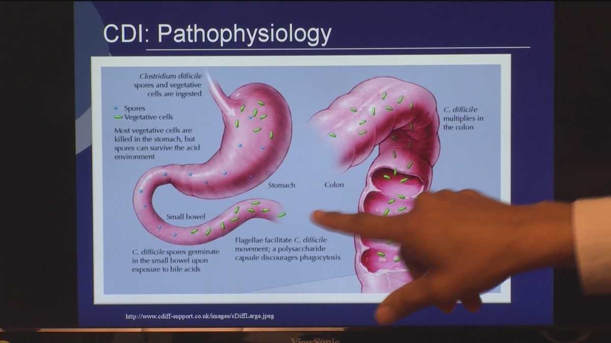 Fecal transplant can help alleviate C. diff pain