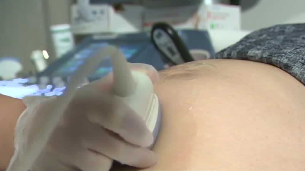 High blood pressure rising in pregnant women; Norton doctor discusses why
