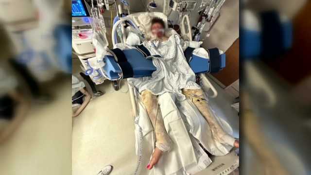 'Unrecognizable:' TikTok challenge leaves Wake Forest teen with burns on nearly 80% of his body - Vimarsana News