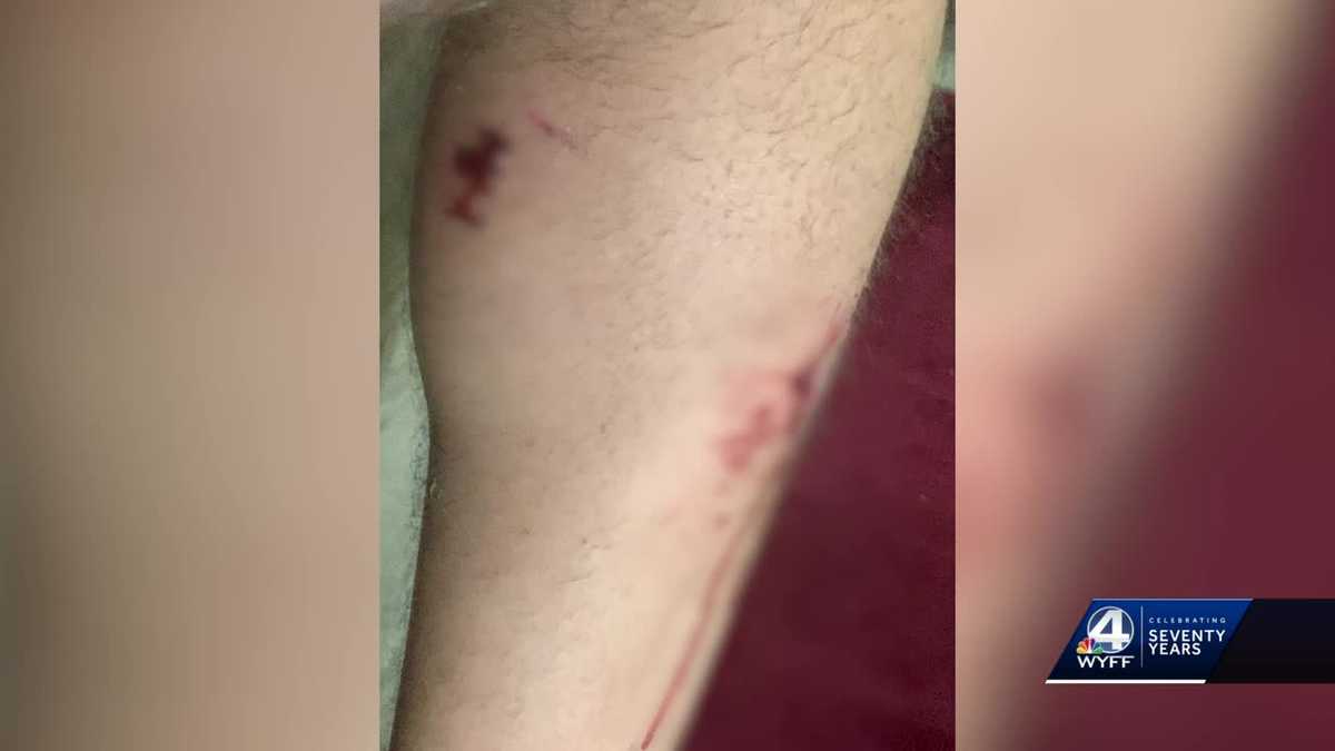 Man who survives being attacked by 4 dogs