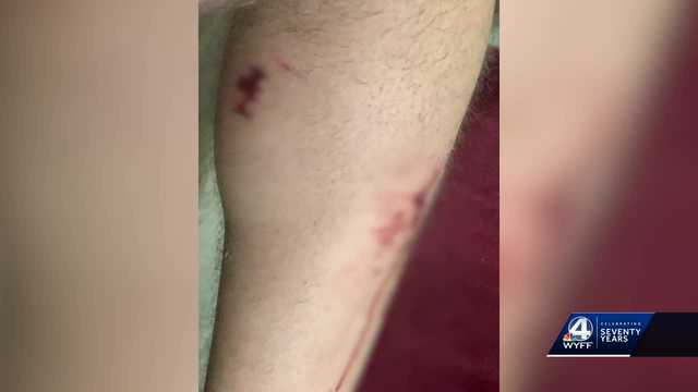 South Carolina: Man who survives being attacked by 4 dogs - Vimarsana News