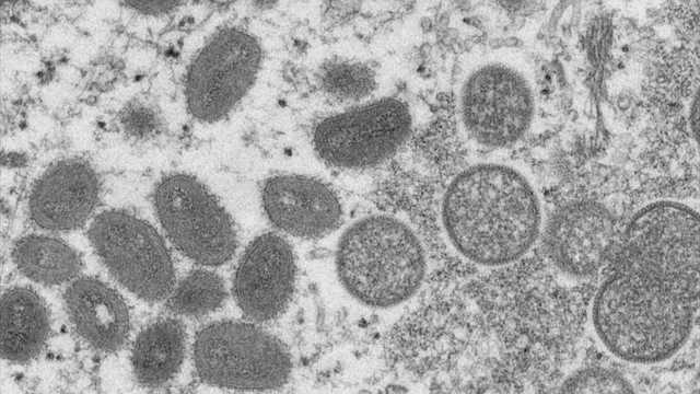 First probable case of monkeypox diagnosed in Monterey County - Vimarsana News