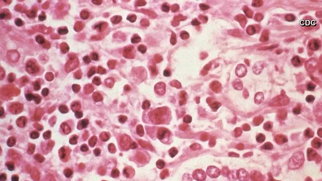'Go travel': Public health agencies say hantavirus spread is little cause for concern