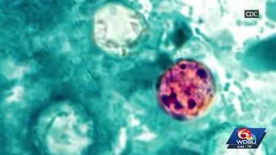 Louisiana Cyclospora cases climb again. See the latest case countwdsu