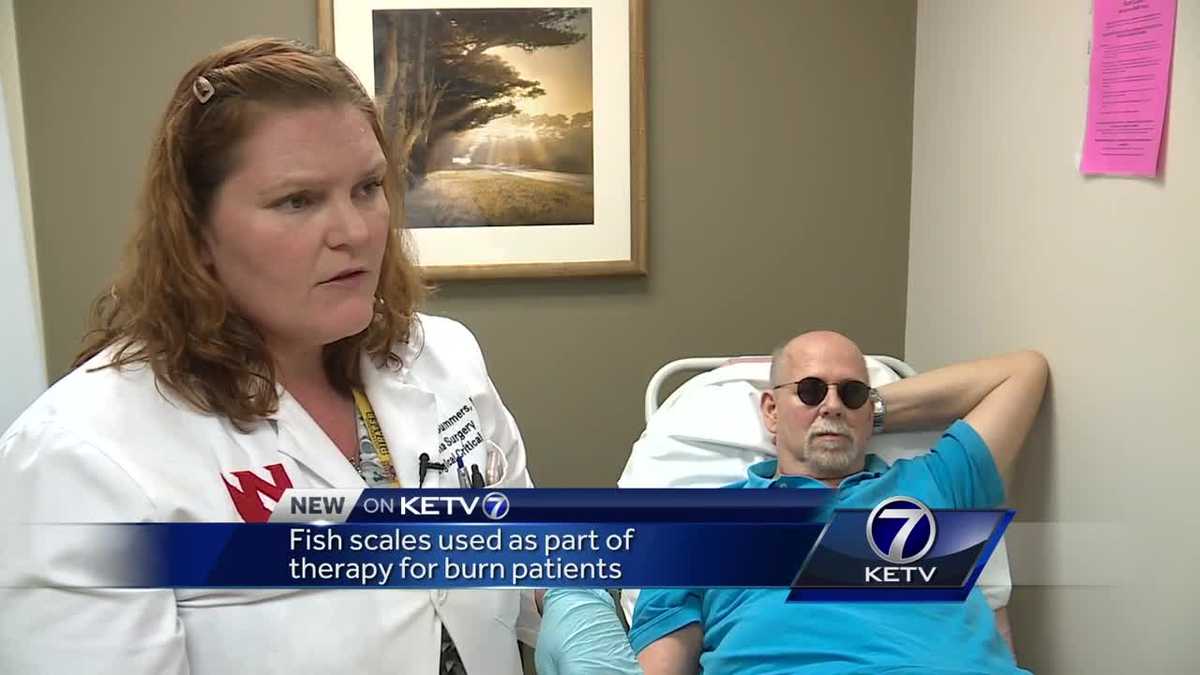 Fish scales used as part of therapy for burn patients