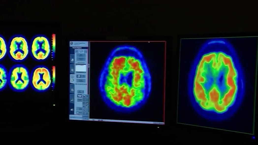 American Stroke Month | Central Florida doctor explains potential signs, symptoms and steps to take