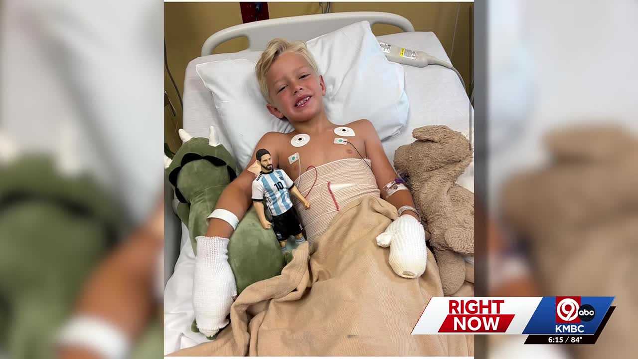 Kansas City boy upset his Lionel Messi jersey was ruined in fire pit accident as his recovery continues