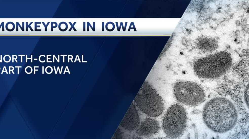Primer caso de viruela símica confirmado en Iowa