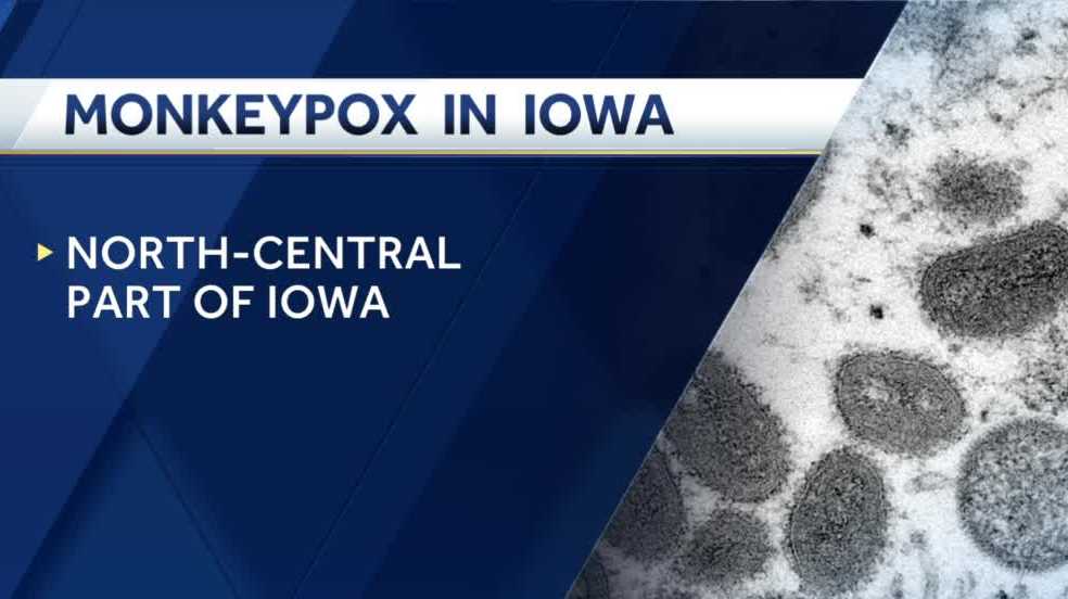 First monkeypox case confirmed in Iowa - KCCI Des Moines