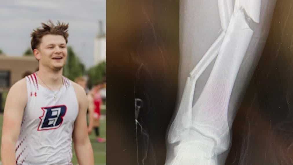 Ballard senior overcomes gruesome leg injury to qualify for Iowa state track meet