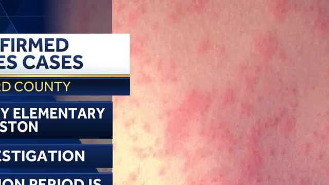 Officials confirm more measles cases at Florida elementary school - Vimarsana News